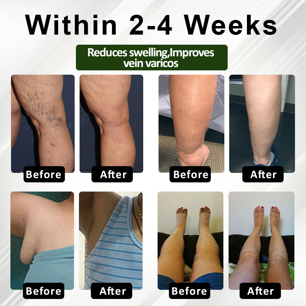 FluidEase Leg Therapy Edema Cream – See results within just one week!