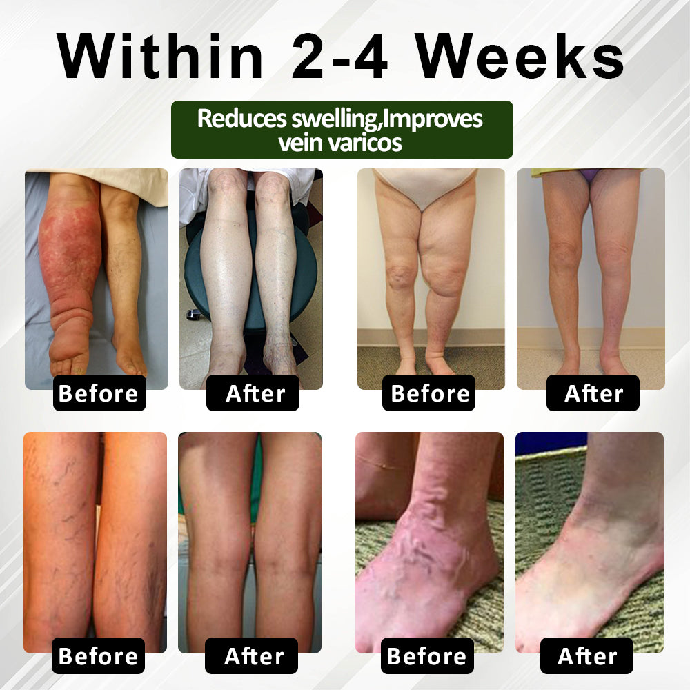 FluidEase Leg Therapy Edema Cream – See results within just one week!