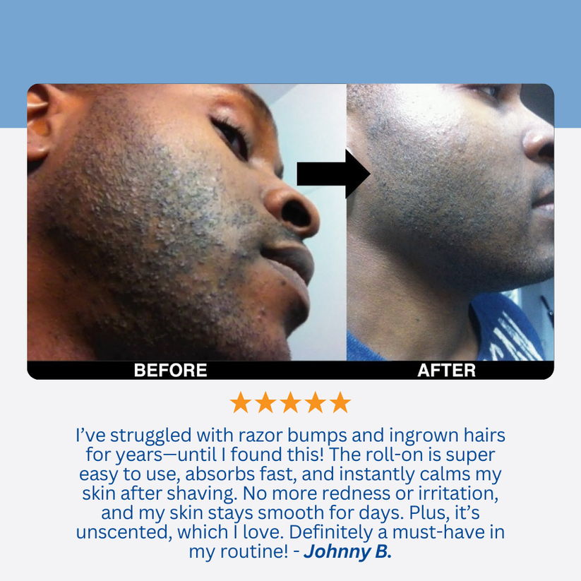 Smoothing Solution Ingrown Hair Treatment: Glide Your Way to Silky-Smooth, Bump-Free Skin