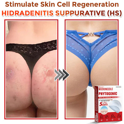 Skavix® MicroNeedle Botanic Skin Tag Removal Patch ✅Australian Made