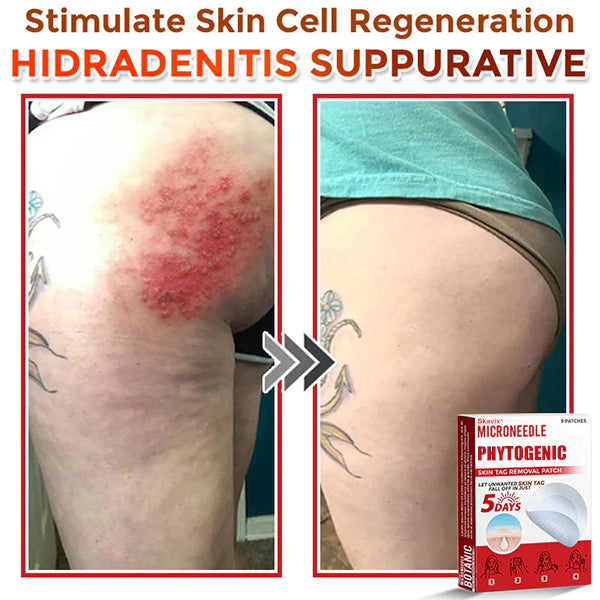 Skavix® MicroNeedle Botanic Skin Tag Removal Patch ✅Australian Made
