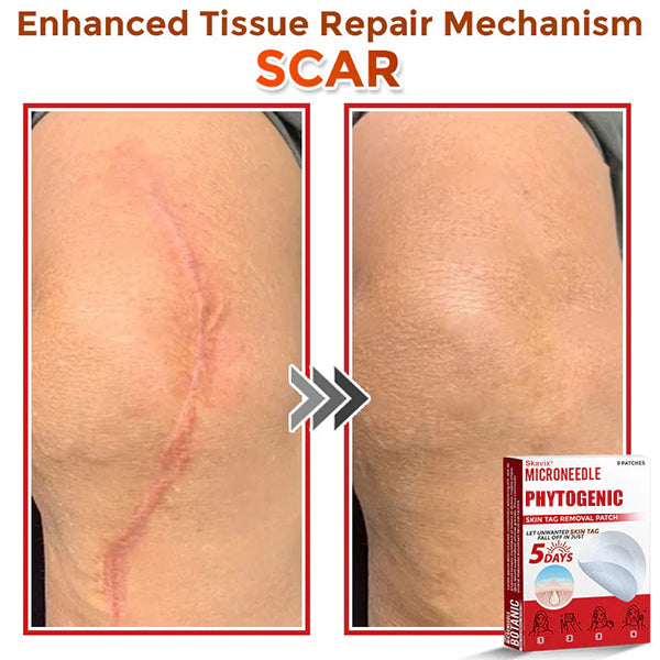 Skavix® MicroNeedle Botanic Skin Tag Removal Patch ✅Australian Made
