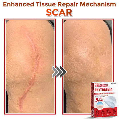 Skavix® MicroNeedle Botanic Skin Tag Removal Patch ✅Australian Made