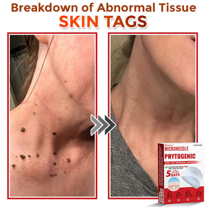 Skavix® MicroNeedle Botanic Skin Tag Removal Patch ✅Australian Made