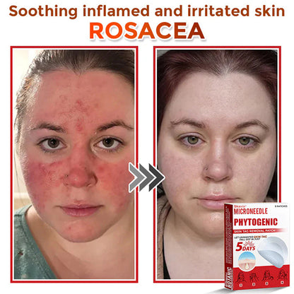 Skavix® MicroNeedle Botanic Skin Tag Removal Patch ✅Australian Made