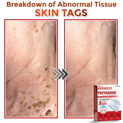 Skavix® MicroNeedle Botanic Skin Tag Removal Patch ✅Australian Made