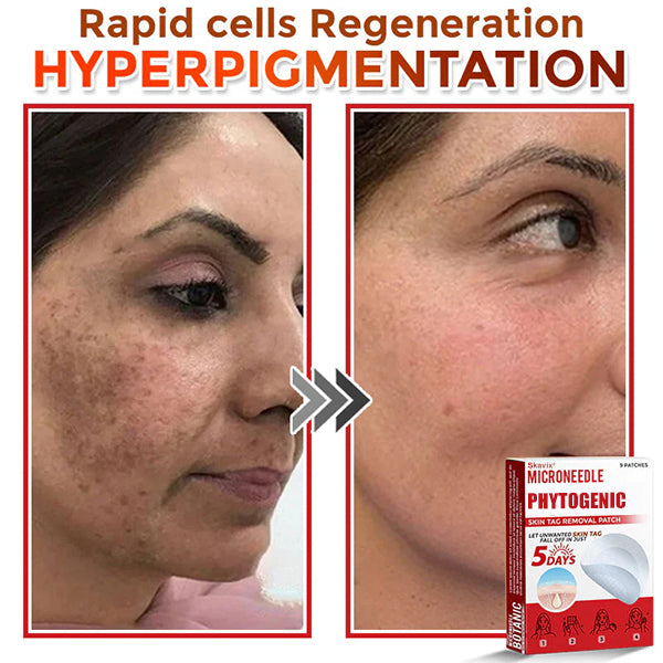 Skavix® MicroNeedle Botanic Skin Tag Removal Patch ✅Australian Made
