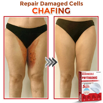 Skavix® MicroNeedle Botanic Skin Tag Removal Patch ✅Australian Made