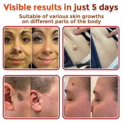 Skavix® MicroNeedle Botanic Skin Tag Removal Patch ✅Australian Made